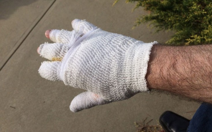 Τον δάγκωσε και του έκοψε το δάχτυλο για… δύο ευρώ