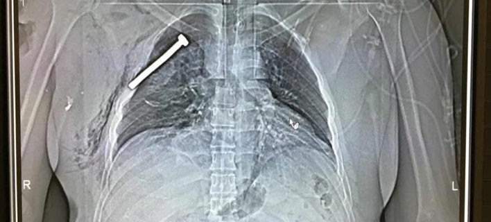 Επίθεση Βρυξέλλες: Ακτινογραφία ενός εκ των τραυματιών επιβεβαιώνει τα καρφιά στις βόμβες (φωτό)