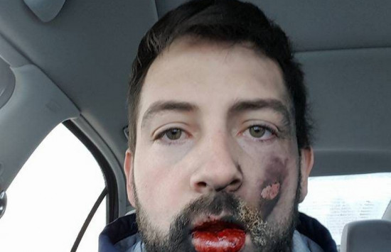 ΗΠΑ: Εξερράγη το ηλεκτρονικό τσιγάρο στο στόμα του – Δείτε τι έπαθε (φωτό)