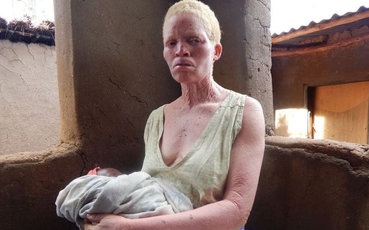 «Φοβάμαι να κοιμηθώ γιατί θα με δολοφονήσουν» καταγγέλλει γυναίκα Αλμπίνος στο Μαλάουι