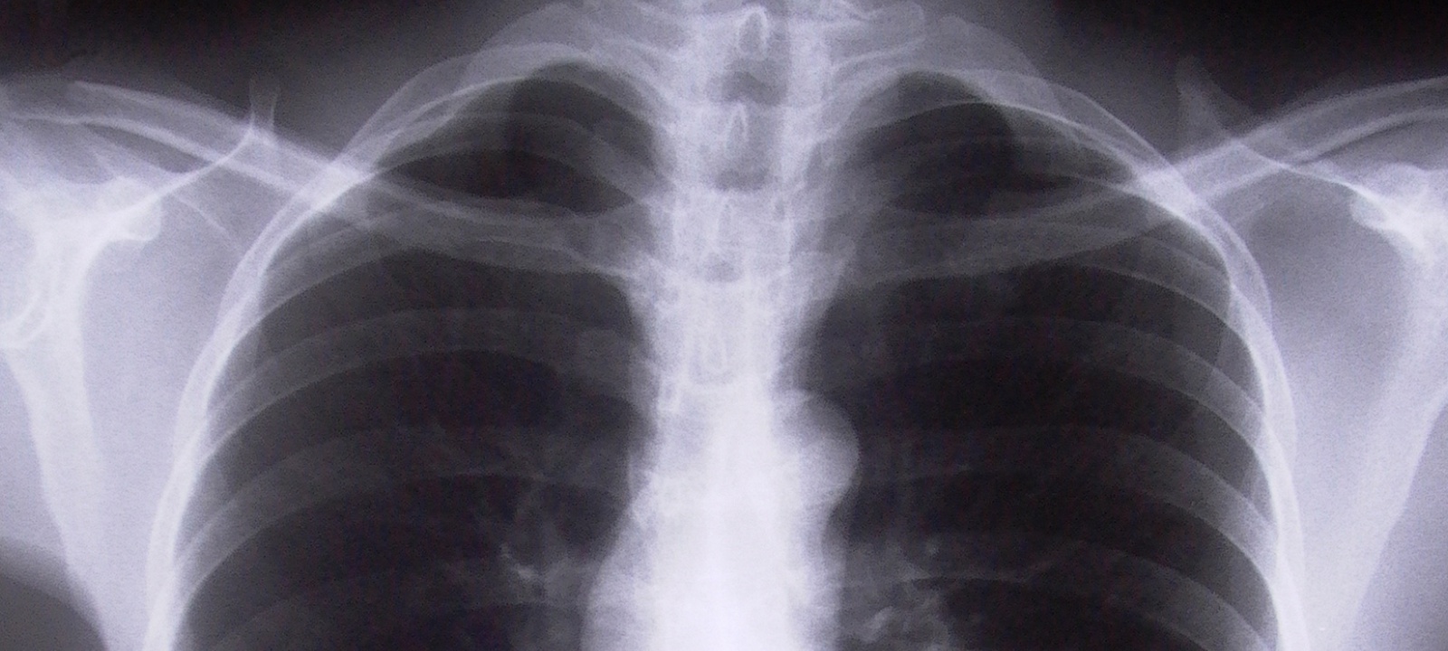 Φρικιαστική υπόθεση στο Ηράκλειο: Ακτινογραφία 17χρονης μαθήτριας αποκάλυψε την κακοποίηση που δέχτηκε από 45χρονο