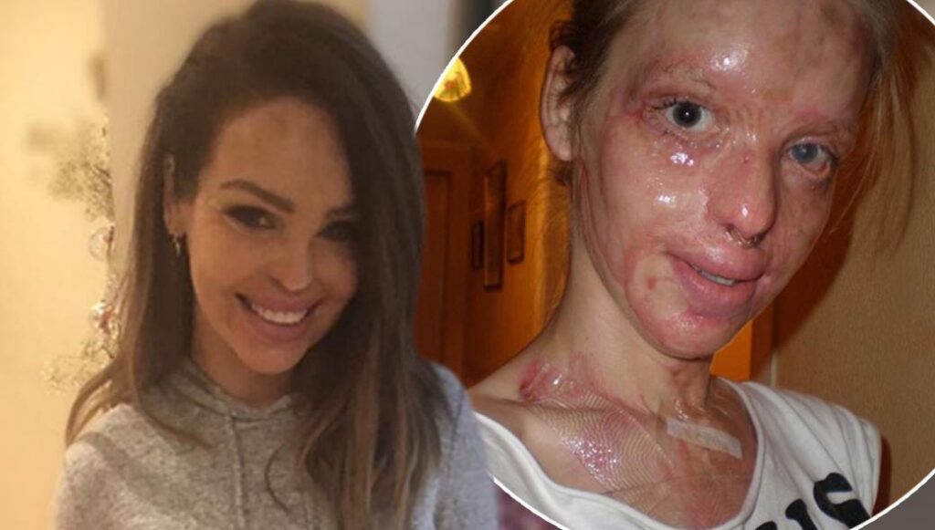 Η επίθεση με οξύ στην 24χρονη Katie Piper: Τα 40 χειρουργεία & το θαύμα της αποκατάστασης (βίντεο)
