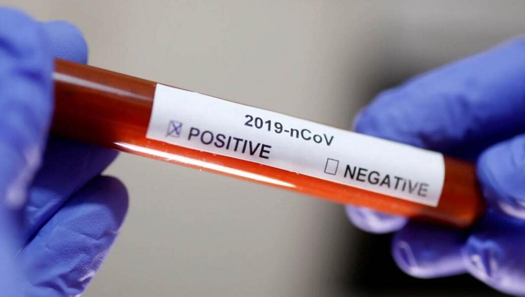 Όλα για το χρήμα: Απείλησαν ιδιοκτήτη διαγνωστικού κέντρου επειδή πουλούσε το τεστ κορωνοϊού… πολύ φθηνά