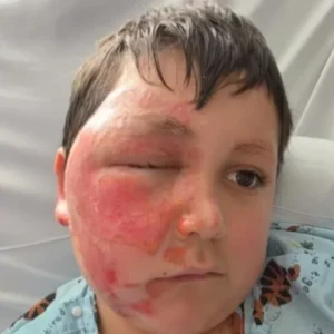 Το επικίνδυνο challenge του TikTok με φούρνο μικροκυμάτων: 9χρονος υπέστη σοβαρά εγκαύματα (βίντεο)