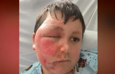 Το επικίνδυνο challenge του TikTok με φούρνο μικροκυμάτων: 9χρονος υπέστη σοβαρά εγκαύματα (βίντεο)