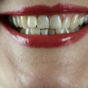 Εφιάλτης για Βρετανίδα στην Τουρκία: Πήγε για να φτιάξει τα δόντια της και έμεινε… φαφούτα – Δεν μπορεί να φάει